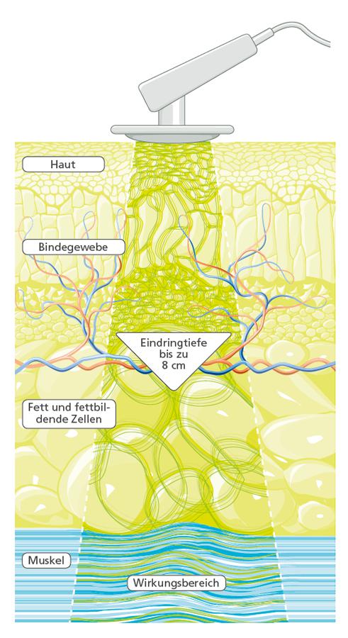 DEEP OSCILLATION® Evident CLINICS